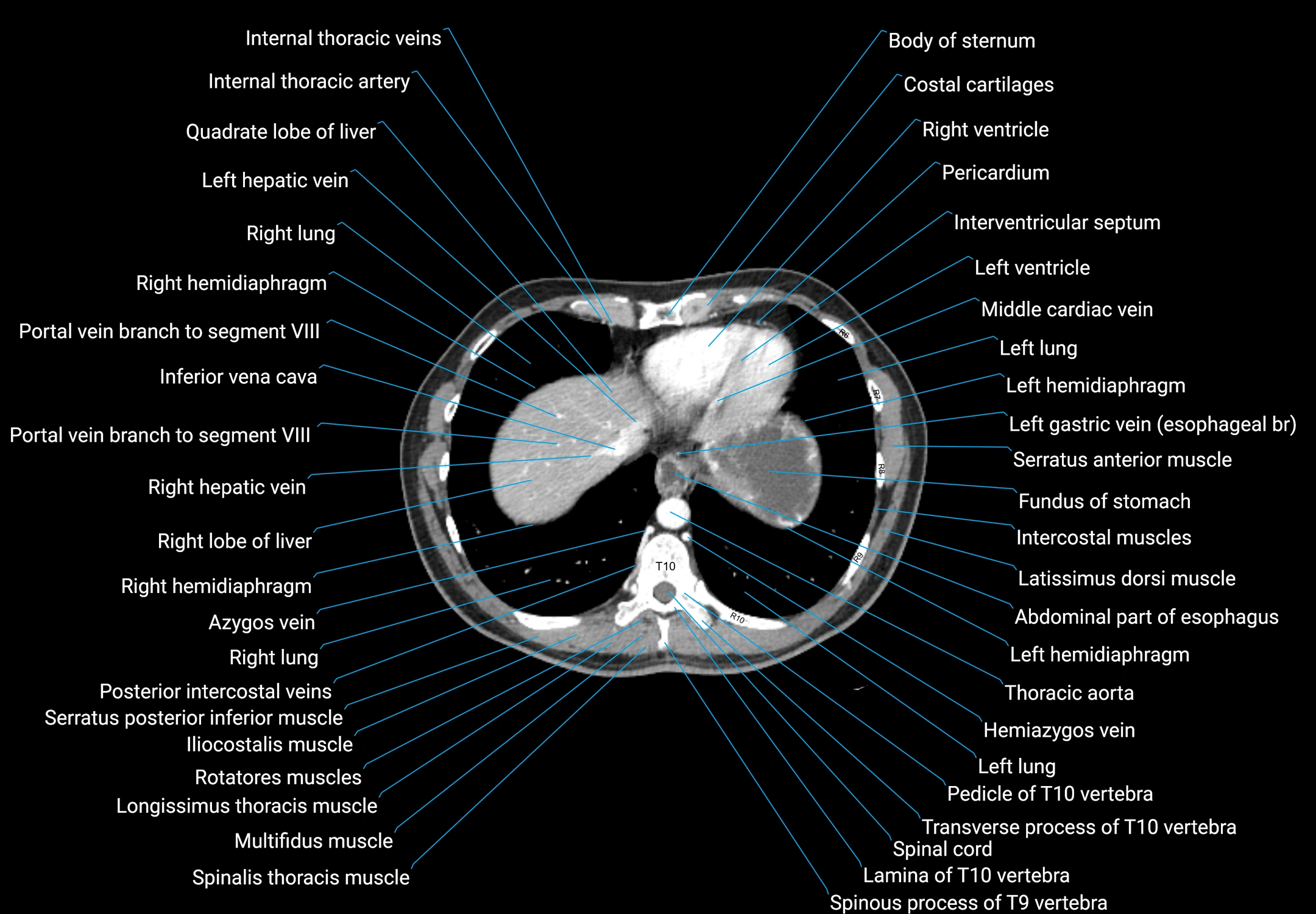 CT male pelvis axial cross sectional anatomy labelled radiology image -00013.webp